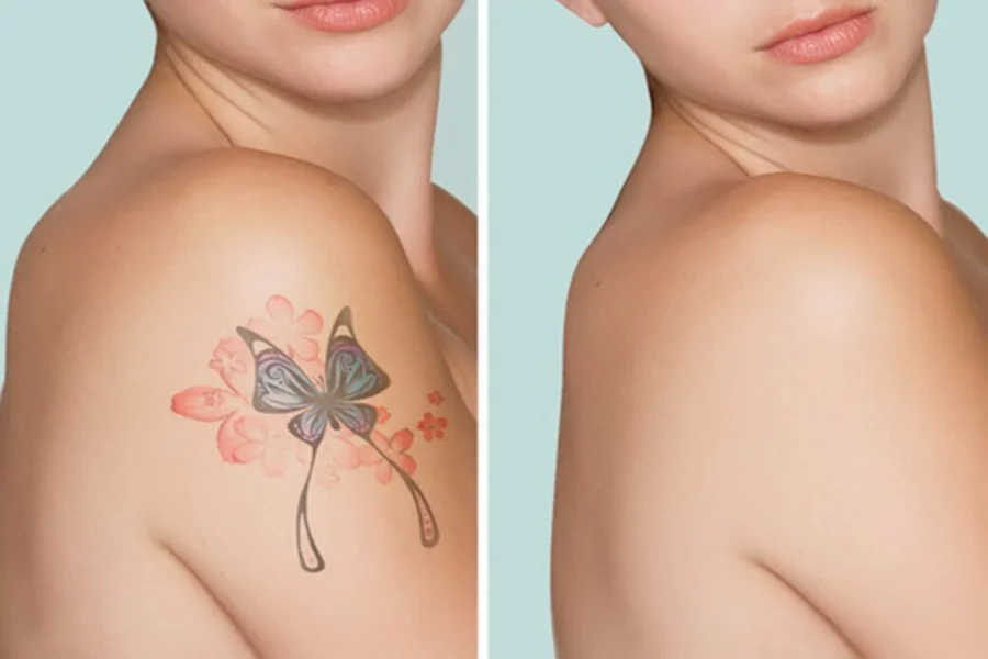 Tattoo Removal